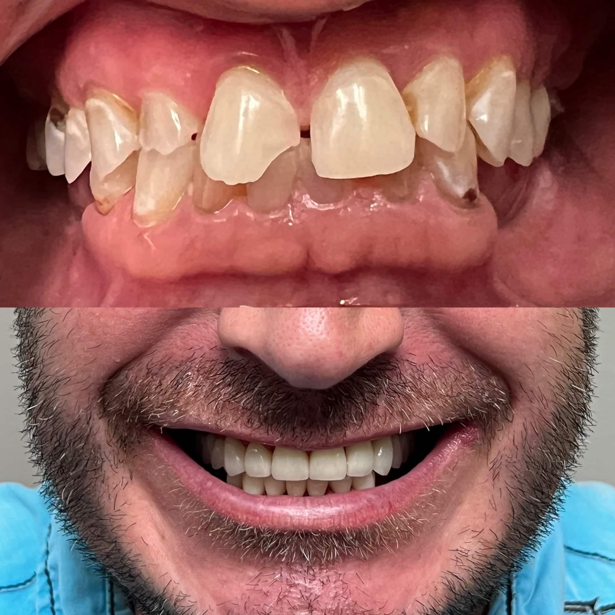 Full Mouth Reconstruction - closed